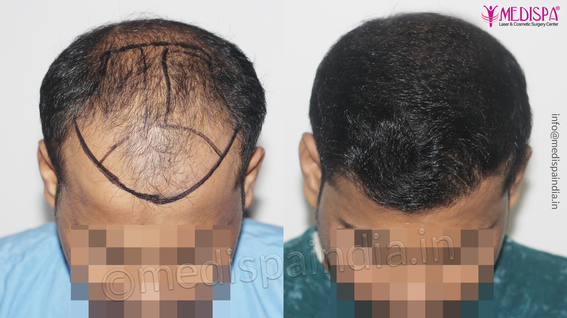 Medispa Hair Transplant Center, Jaipur