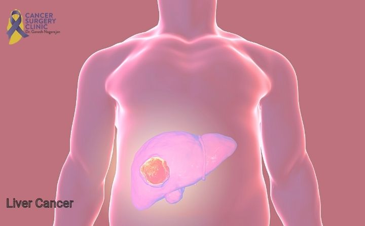 Liver Cancer Treatment in Mumbai