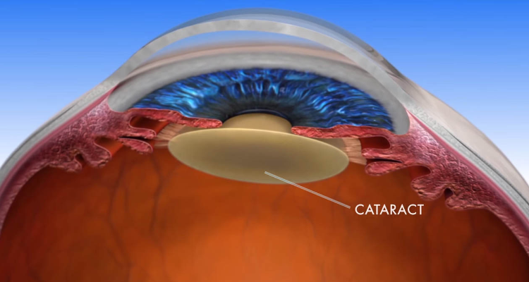 ASG EYE HOSPITALS