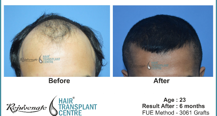 Rejuvenate Hair Transplant Centre