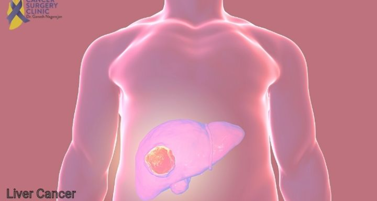 Liver Cancer Treatment in Mumbai